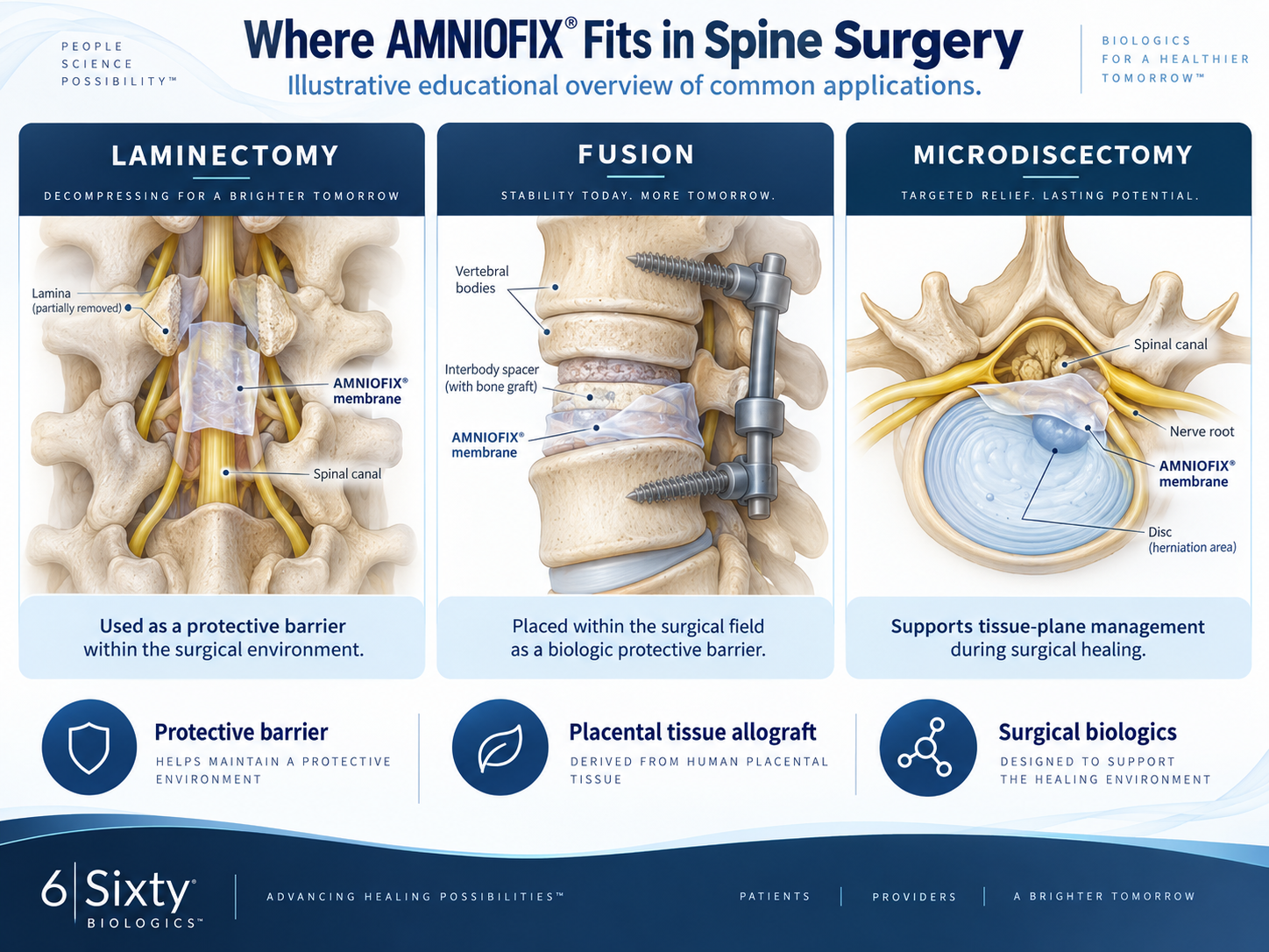 Infographic showing where MiMedx AMNIOFIX fits in spine surgery including laminectomy fusion and microdiscectomy