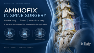 MiMedx AMNIOFIX in spine surgery for laminectomy fusion and microdiscectomy applications